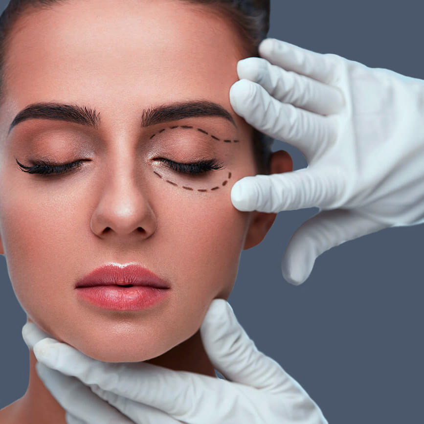 Upper Eyelid Surgery