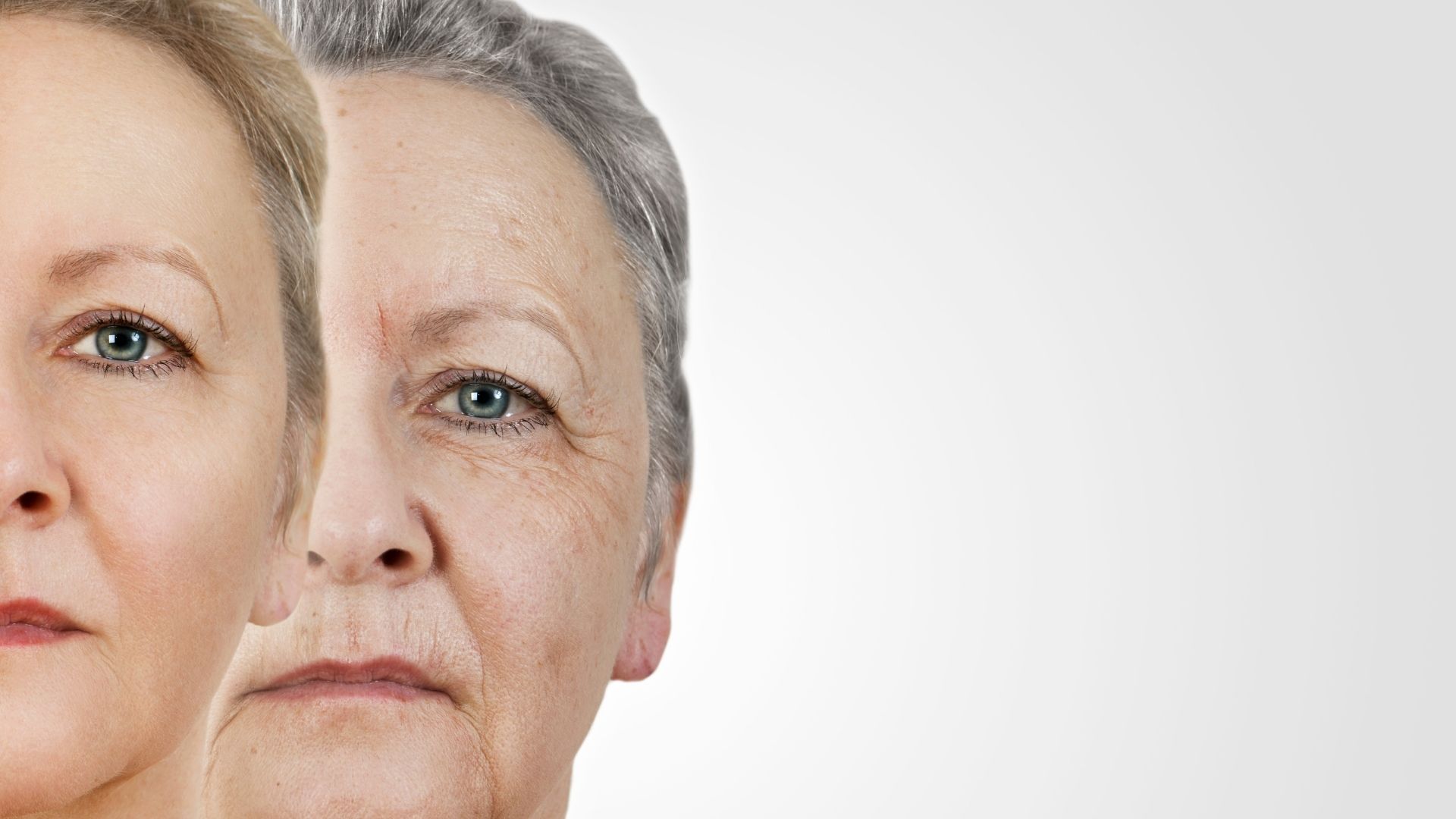 Deep Plane Neck Lift